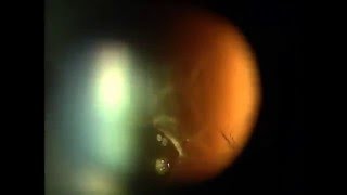 Витреолизис (лазерное лечение 