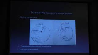 YAG-лазерный витреолизис. Нюансы техники и оценка эффективности